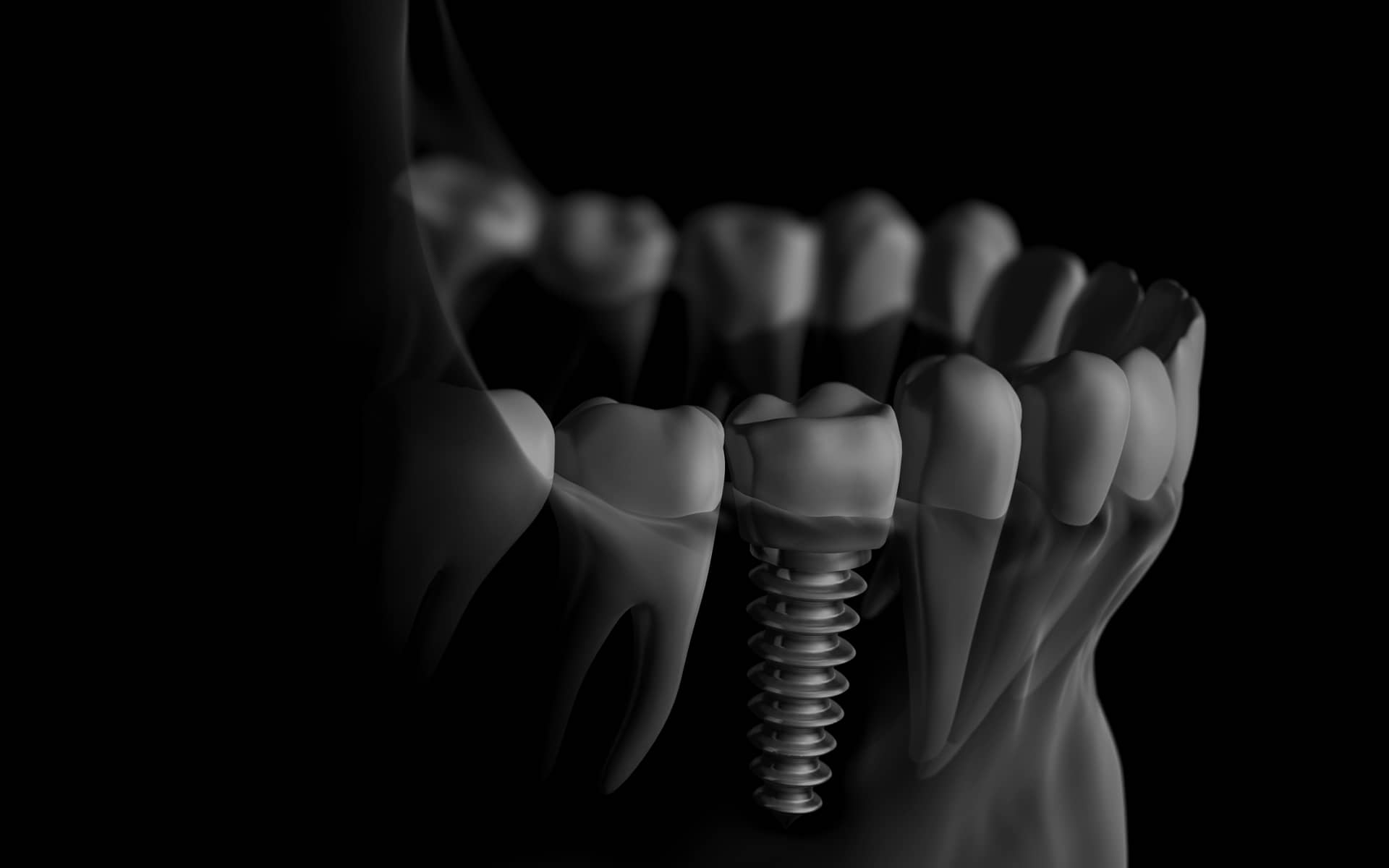 Dental Implants in Canford Cliffs, Bournemouth